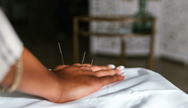 acupuncture pour le stress